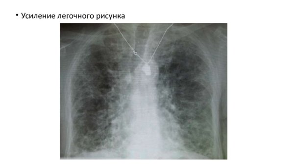 Типы усиления легочного рисунка