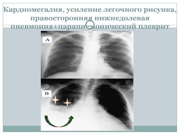 Микоплазма пневмония рентген