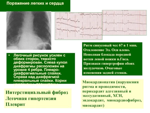 Деформация легочного рисунка на рентгене