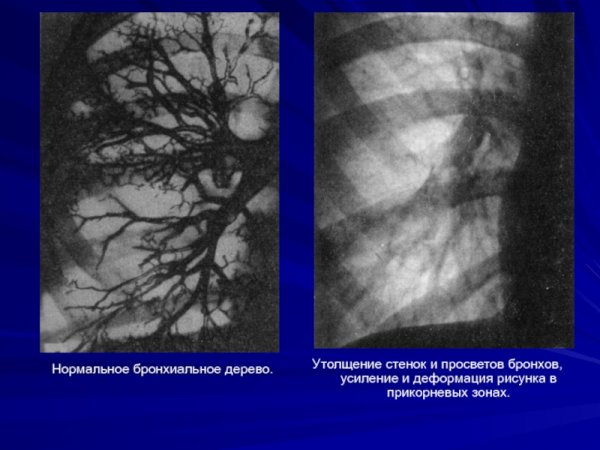 Усиление легочного рисунка