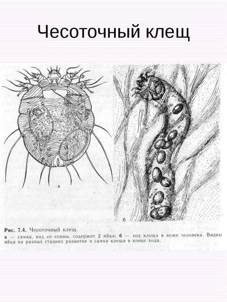 Диагностические признаки чесоточного зудня