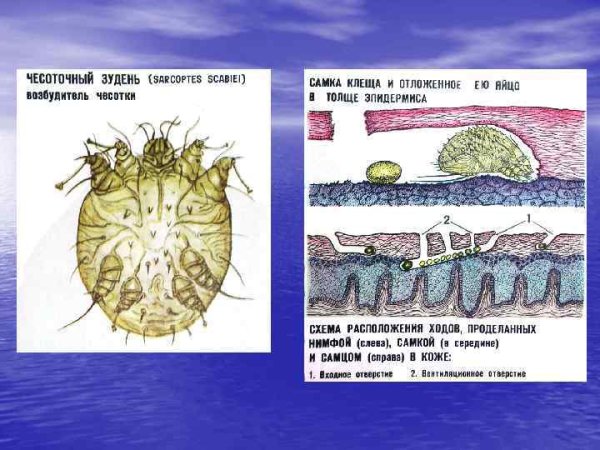Клещ гамазовый чесоточный зудень
