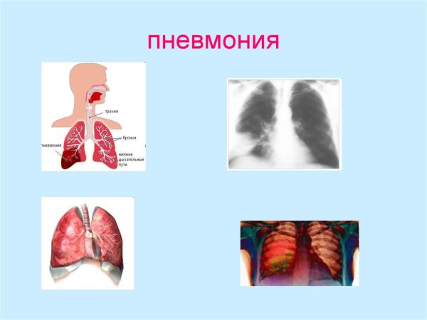 Пневмония картинки