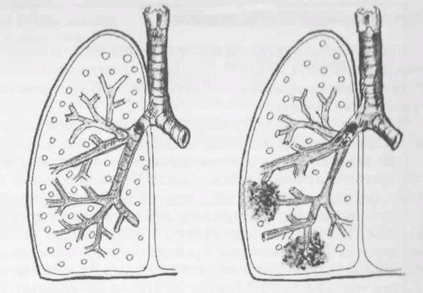 Пневмония и бронхопневмония