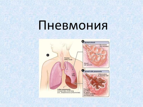 Презентация на тему пневмония