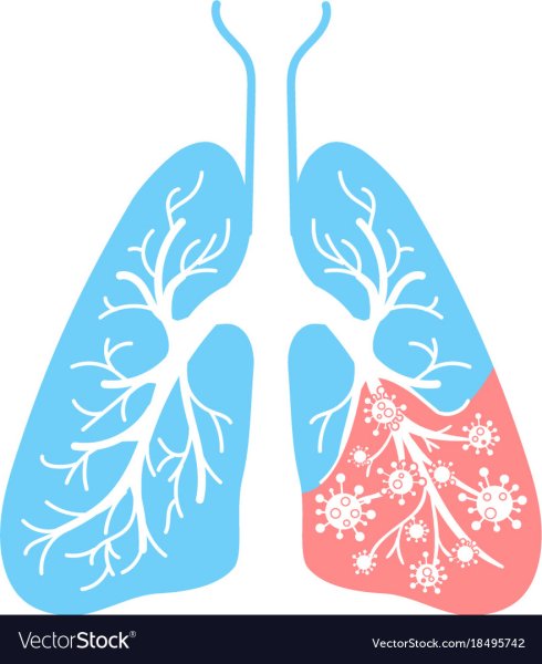 Легочные проявления пневмонии