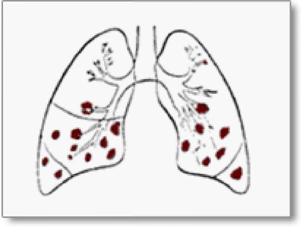 12 Ноября Всемирный день борьбы с пневмонией