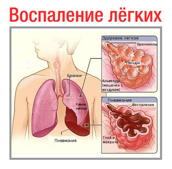 Иконка воспаление легких
