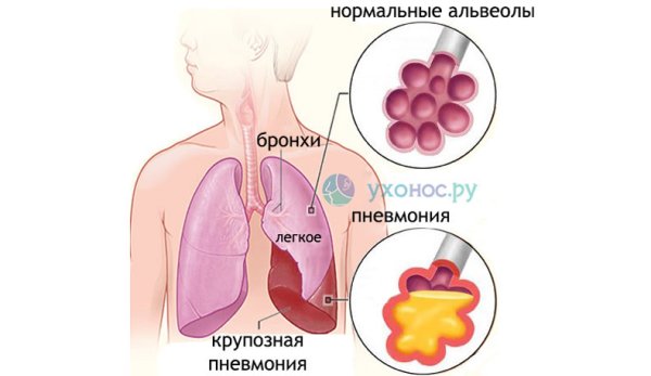 Пневмония плакат