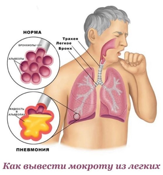 Заболевания дыхательной системы пневмония