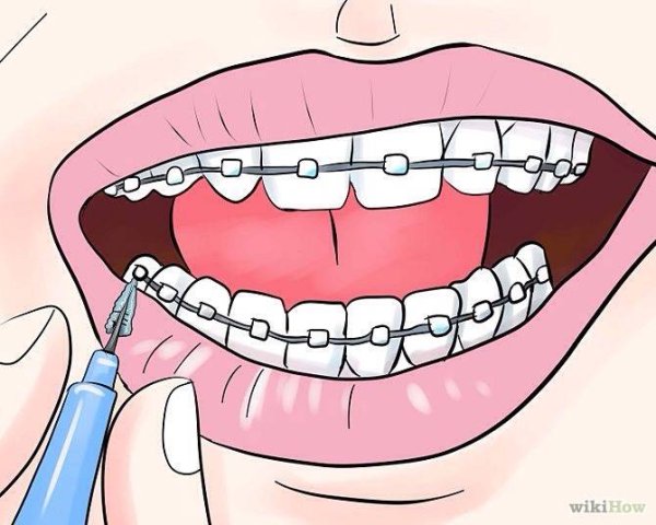 Брекеты нарисованные