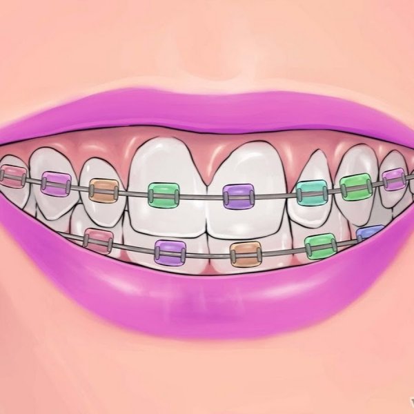 Брекеты рисунок