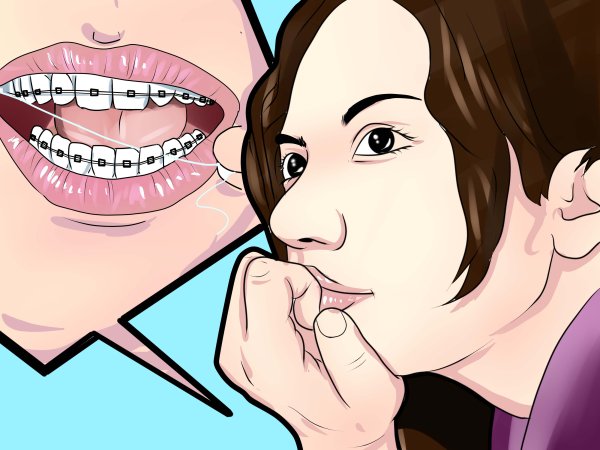 Брекеты арт