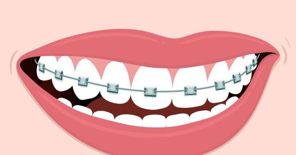 Улыбка с брекетами рисунок