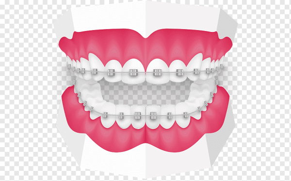 Брекеты без фона