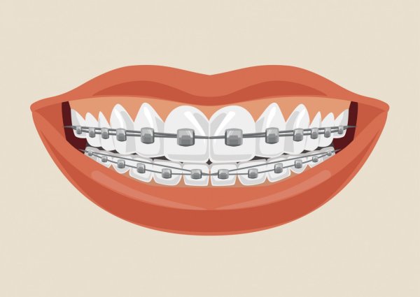 Брекеты нарисованные