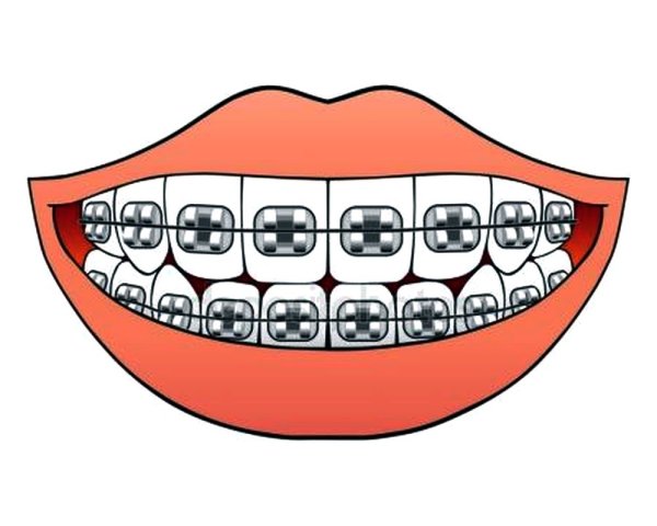 Картина зубы с брекетами