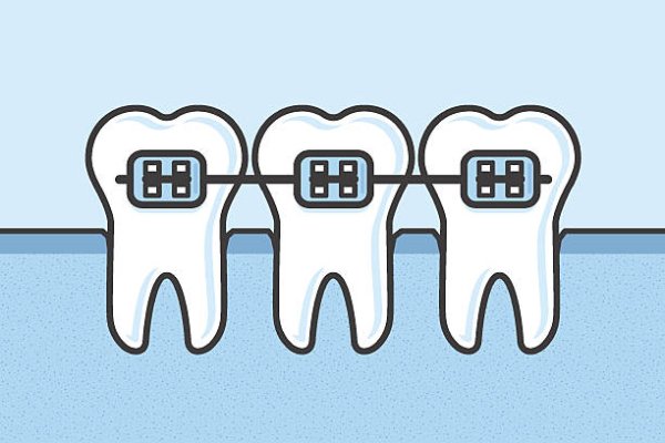 Зуб с брекетом вектор