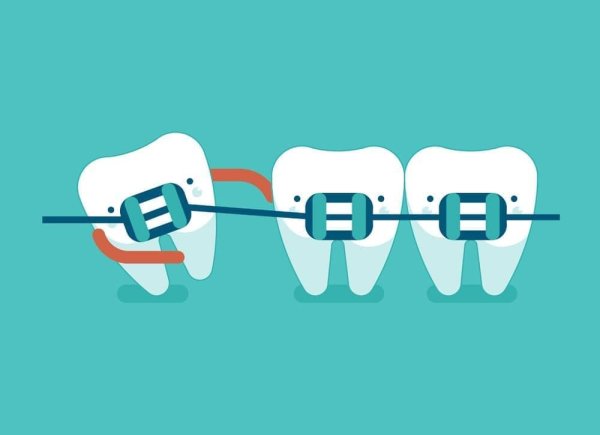Брекеты вектор