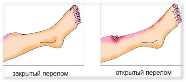 Закрытый перелом и открытый перелом