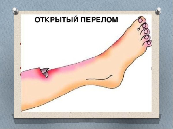 Презентация на тему открытый перелом