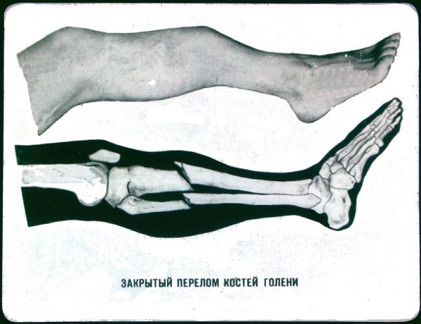 Закрытый перелом костей голени