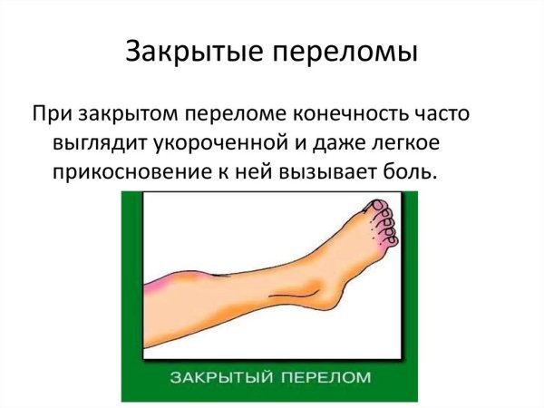 Открытый перелом презентация