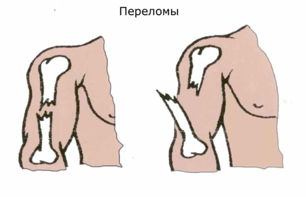 Открытый ПЕРЕЛОМПЕРЕЛОМ