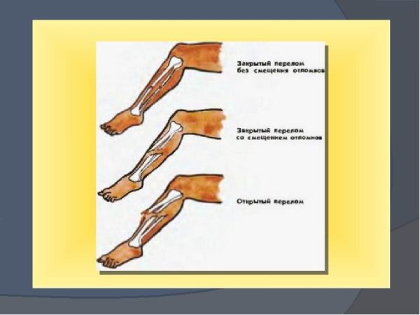 Открытый перелом без смещения