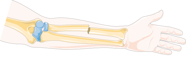 Открытый перелом кости