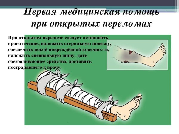 Кровотечение при открытом переломе