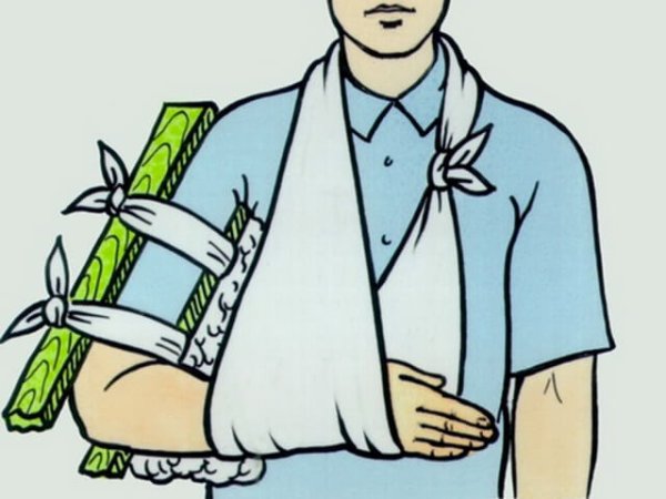 Первая помощь при закрытом переломе