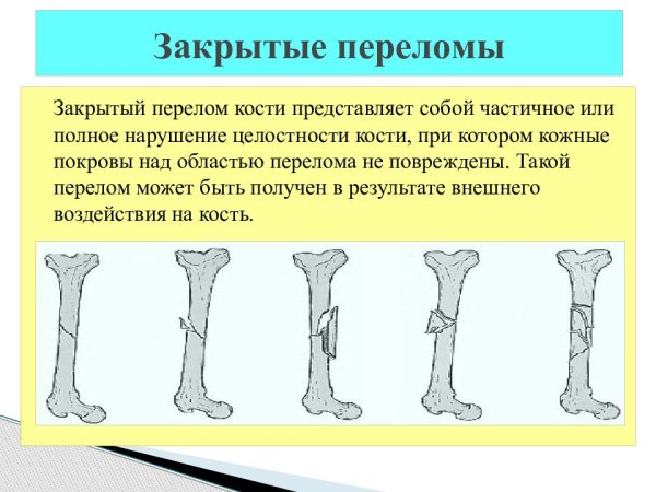 Перелом кости - частичное или полное нарушение целостности кости