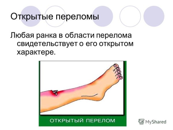 Первично открытый перелом