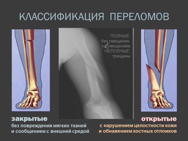 Перелом без смещением костных отломков