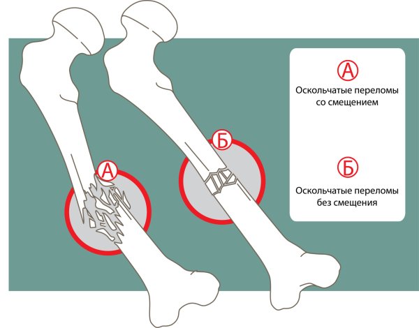 Оскольчатый перелом бедра схема