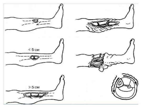 Открытый перелом ноги степень