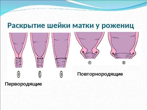 Раскрытие шейки матки