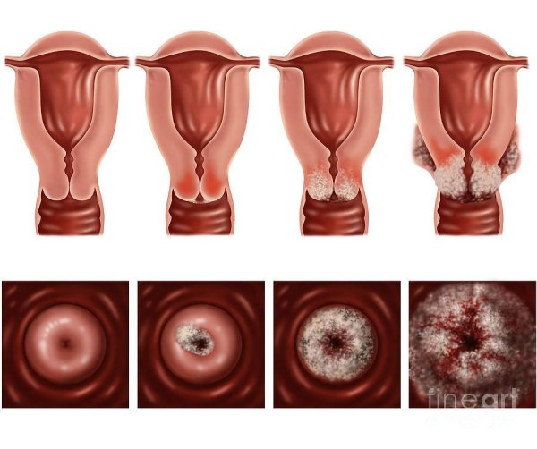 Предраковые заболевания шейки матки
