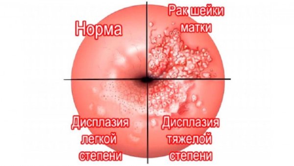 Структура эпителия шейки матки