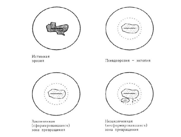Матка рожавшей женщины и нерожавшей