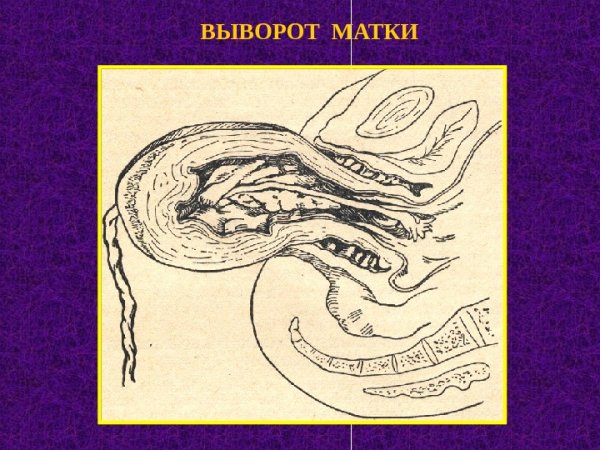 Дисплазия шейки матки 2 степени гистология