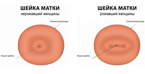 Дисплазия шейки матки симптомы
