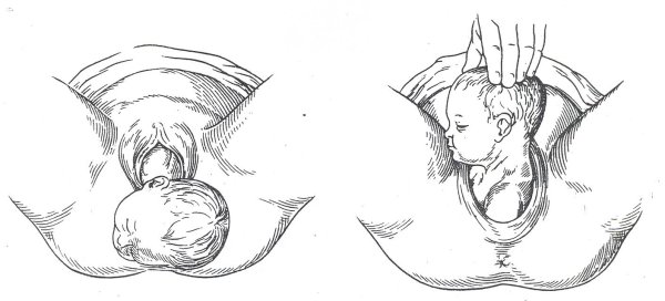 Эрозия слизистой шейки матки