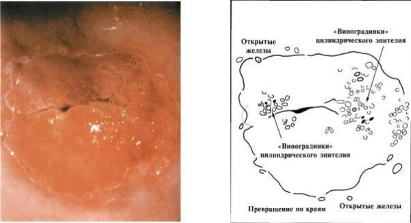 Формирование Нижнего маточного сегмента
