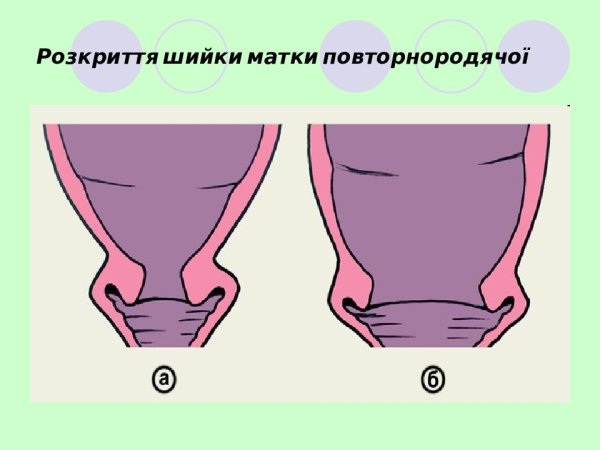 Эрозированный эктропион шейки матки