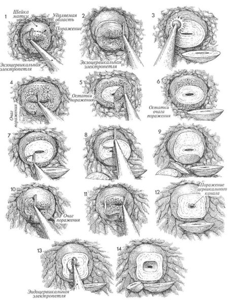 Лимфоцитарный цервицит