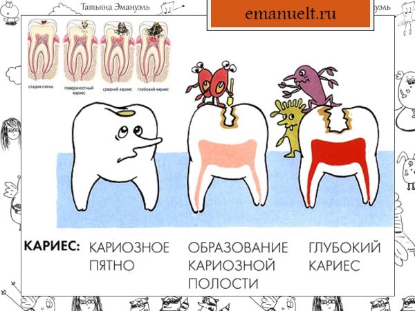 Схема образования кариеса