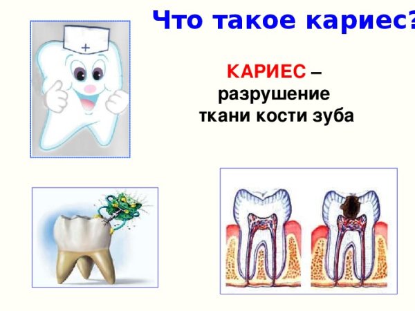 Кариес зубов презентация