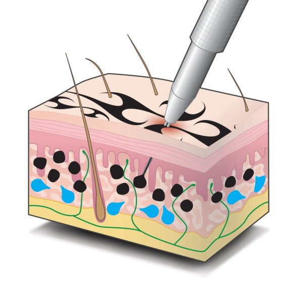 Введение пигмента в кожу
